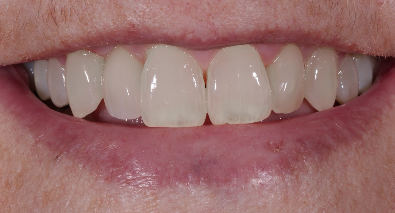 The Care - After - Implant