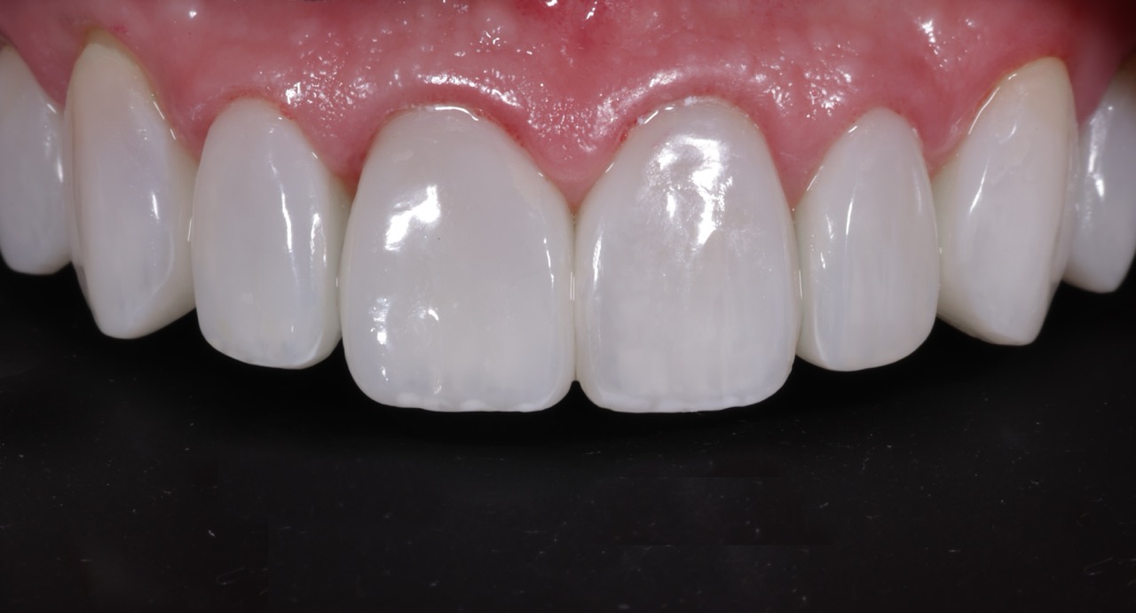 The Care - Before - Intraoral
