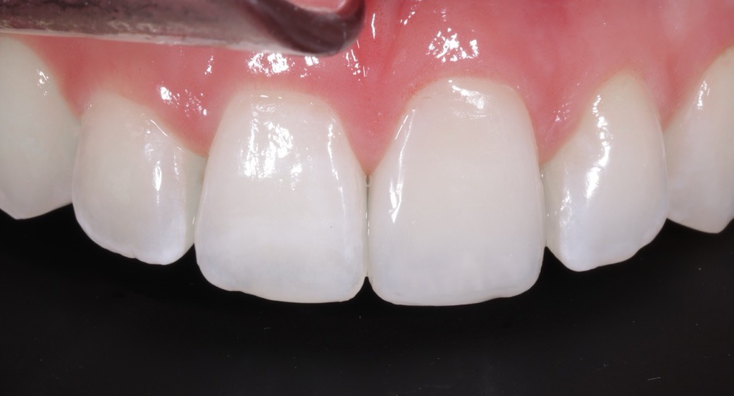 The Care - After - Single Tooth