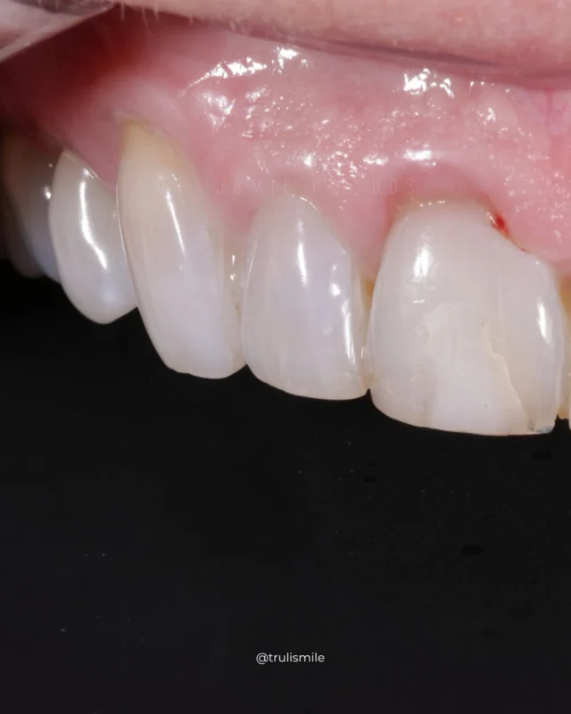 Have a special event coming up? We got you.
No shaving teeth, 48hr transformation. 

Yours, but better 😘

#sacramentodentist #cosmeticdentistry #marshallhansonmethod #compositeveneers
