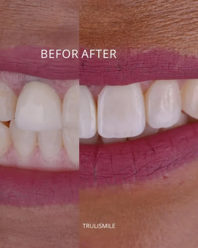 Just enough to feel like you again. Upper 4. No prep. No shaving. 

One porcelain crown replaced to match. 

This is what subtle transformation looks like.

Wanna see what’s possible? Link in bio 

#compositeveneers #sacramentodentist #noprepveneers #marshallhansonmethod #trulismile